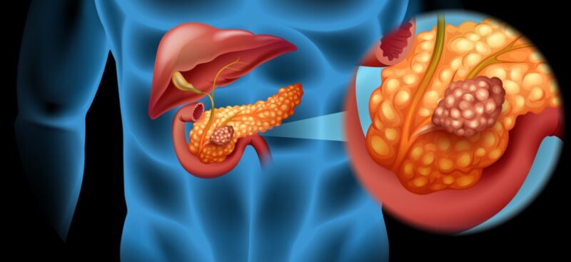 pancreas-cancer-illustration